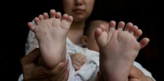 Los padres de un niño que nació con 31 dedos piden ayuda para pagar la operación.