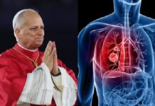 León XIV será internado mañana para su operación por un nódulo pulmonar papa